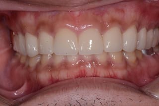 Before After Dental Case