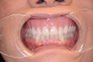 Before After Dental Case