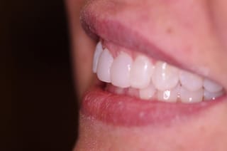 Before After Dental Case