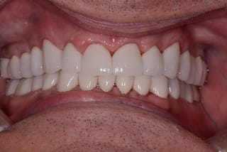 Before After Dental Case