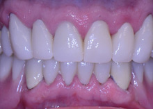 Before After Dental Case