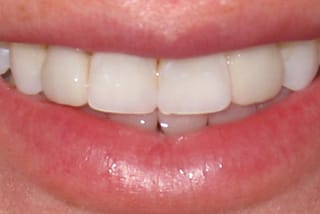 Before After Dental Case