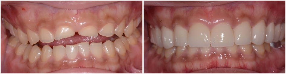 Slide 1 - teeth going from uneven to nice and even and white 