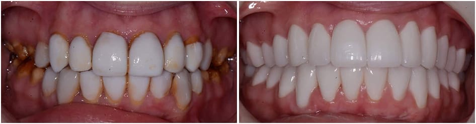 Slide 2 - teeth going from yellow and corroded to white