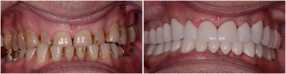 Slide 3 - brown, speckled teeth trandsformed to white.