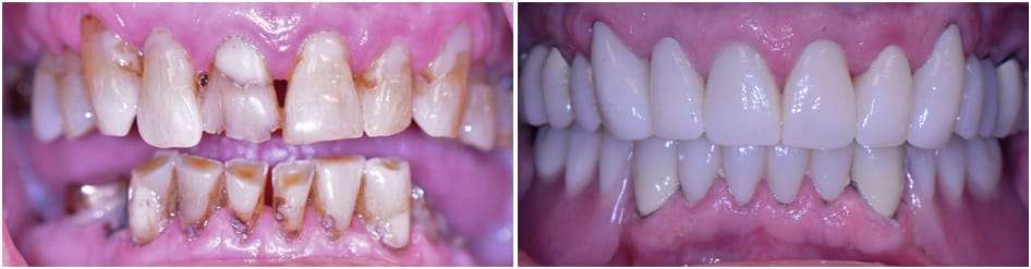 Slide 4 - brown teeth to white teeth